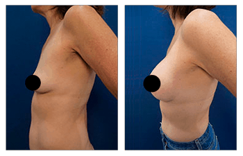 Breast Lift with Implants before and after — view 4