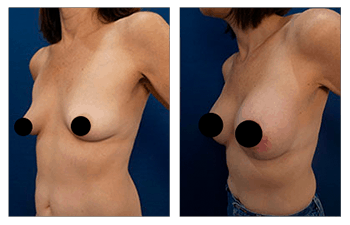 Breast Lift with Implants before and after — view 2