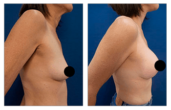 Breast Lift with Implants before and after — view 3