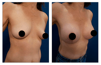 Breast Lift with Implants — #SS378 Breast Lift with Implants — #SS378