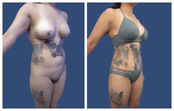 HD Lipo 360 — #SS360 HD Lipo 360 — #SS360