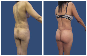 Tummy Tuck — #SS362 Tummy Tuck — #SS362