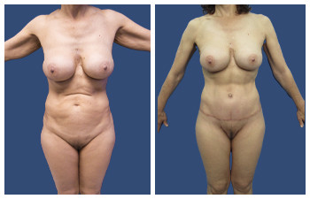 Mini Tummy Tuck — #SS363 Mini Tummy Tuck — #SS363