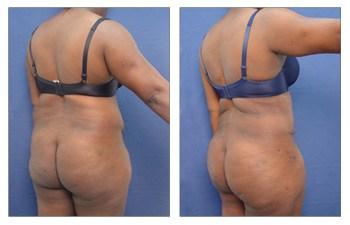 Tummy Tuck with 360 Body Contouring before and after — view 4