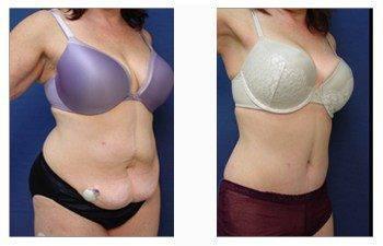 post bariatric surgery patient 8 front right view post bariatric surgery patient 8 front right view