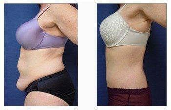 post bariatric surgery patient 8 left view post bariatric surgery patient 8 left view