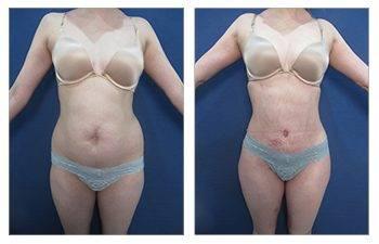 Before and after photos of tummy tuck surgery showcasing the results. Before and after photos of tummy tuck surgery showcasing the results.