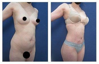 Before and after photos of a tummy tuck procedure, showcasing the effects on the abdomen. Before and after photos of a tummy tuck procedure, showcasing the effects on the abdomen.