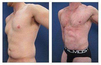 liposuction laser front left view liposuction laser front left view