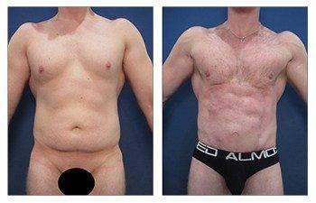 liposuction laser liposuction laser