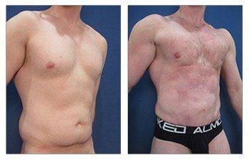 liposuction laser front right view