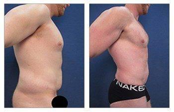Sixpack liposuction Sixpack liposuction