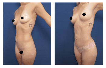 Liposuction Meaning