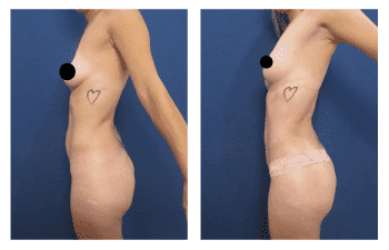Liposuction Meaning