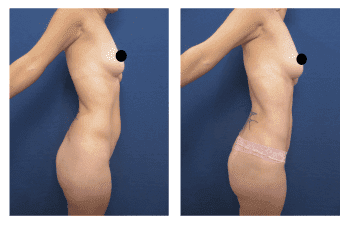 Liposuction Meaning