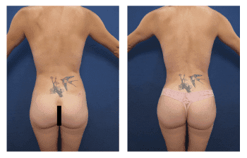 Liposuction Meaning