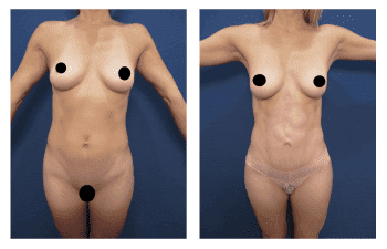 Liposuction Meaning