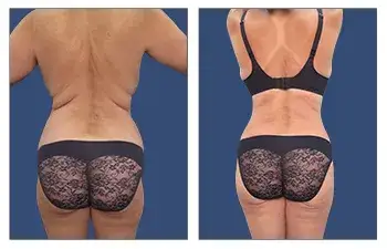 HD Liposuction + Renuvion — #SS049 HD Liposuction + Renuvion — #SS049