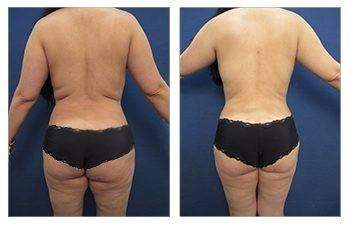 HD Liposuction — #SS047 HD Liposuction — #SS047