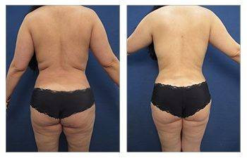 HD Liposuction — #SS047 HD Liposuction — #SS047