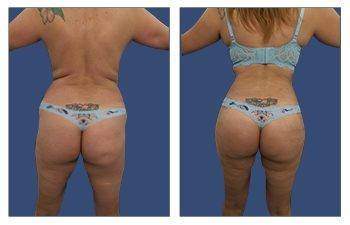 Tummy Tuck — #SS033 Tummy Tuck — #SS033