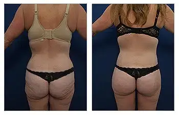 HD Liposuction + BBL — #SS137 HD Liposuction + BBL — #SS137
