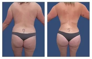 HD Liposuction + BBL — #SS050 HD Liposuction + BBL — #SS050
