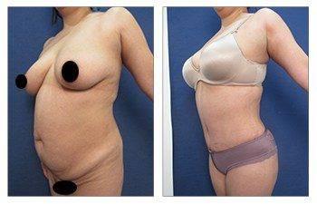 Liposuction Liposuction