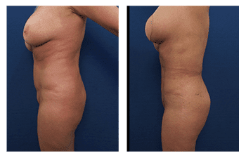 SurgiSculpt - Liposuction Side Effects
