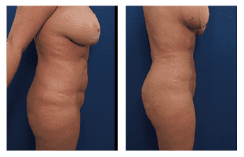 SurgiSculpt - Liposuction Side Effects