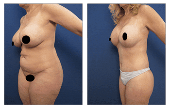 A woman's breasts before and after breast surgery as part of a Mommy Makeover to create improved proportions. A woman's breasts before and after breast surgery as part of a Mommy Makeover to create improved proportions.