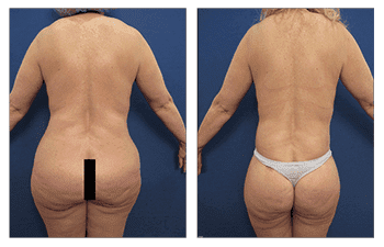 Lower body lift to eliminate buttock sagging and tighten her buttock Lower body lift to eliminate buttock sagging and tighten her buttock