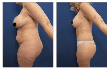 A woman with tattoos before and after breast augmentation, demonstrating the transformative effects of VASER technology. A woman with tattoos before and after breast augmentation, demonstrating the transformative effects of VASER technology.