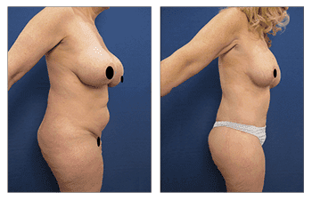 Lower body lift to eliminate buttock sagging and tighten her buttock Lower body lift to eliminate buttock sagging and tighten her buttock