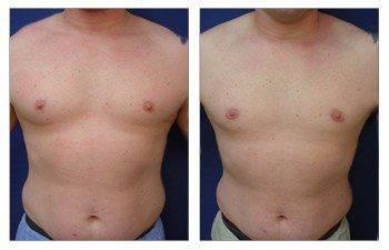 Gynecomastia Gynecomastia