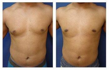 Combining tummy tuck and Lipo for before and after transformations. Combining tummy tuck and Lipo for before and after transformations.