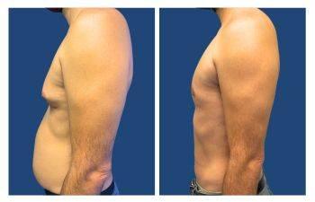 High definition liposuction gynecomastia High definition liposuction gynecomastia