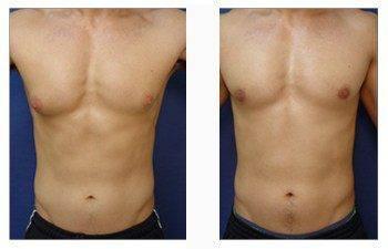 male breast surgery patient 8 front view male breast surgery patient 8 front view