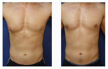 Gynecomastia — #SS274 Gynecomastia — #SS274