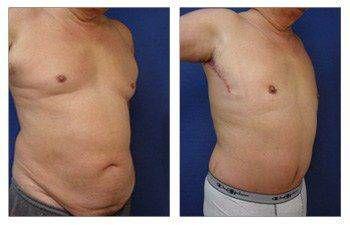 tummy-tuck-patient-34-front-right(1) tummy-tuck-patient-34-front-right(1)