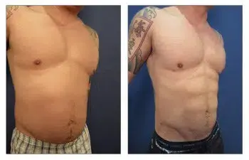 What is Compression Coupling in Liposuction What is Compression Coupling in Liposuction