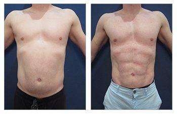 Abdominal Etching Abdominal Etching