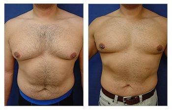 Correct Diastasis Recti with impressive tummy tuck before and after results. Correct Diastasis Recti with impressive tummy tuck before and after results.