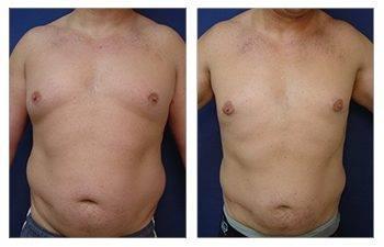 A woman's breast undergoing surgery for skin redundancy, resulting in a before and after transformation. A woman's breast undergoing surgery for skin redundancy, resulting in a before and after transformation.