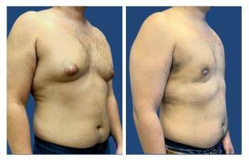 is-gynecomastia-painful? is-gynecomastia-painful?