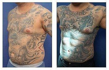 Abdominal-Etching Abdominal-Etching