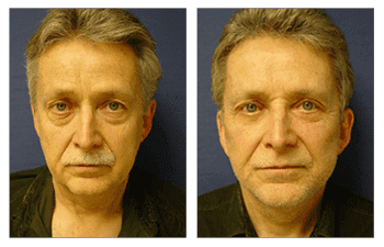 facelift patient 4 front view facelift patient 4 front view
