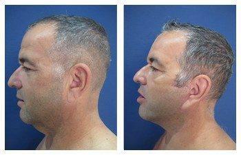 A man's face before and after undergoing a facelift, exploring the transformation and changes brought by the procedure. A man's face before and after undergoing a facelift, exploring the transformation and changes brought by the procedure.