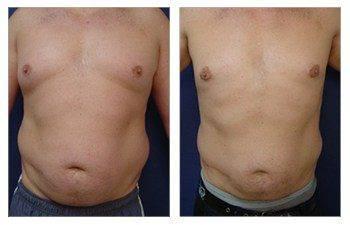 Gynecomastia Gynecomastia