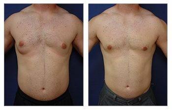 High Definition Abdominal Contouring - See incredible tummy tuck results before and after. High Definition Abdominal Contouring - See incredible tummy tuck results before and after.